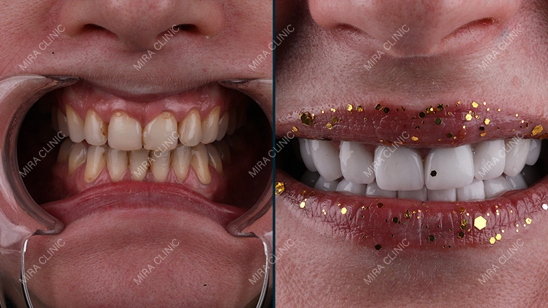 Treatment Performed 6 Implants, 3 Crowns, and E-max Restorations